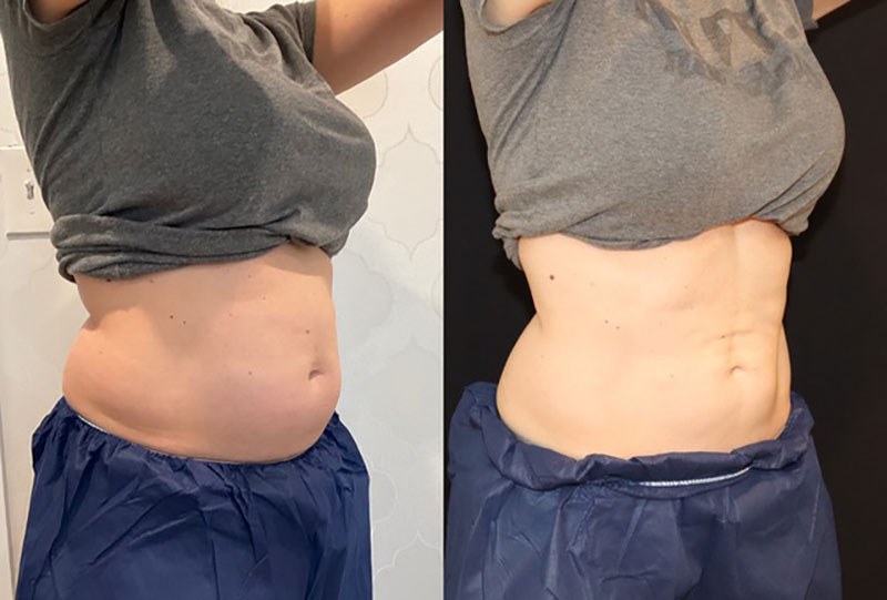 CoolSculpting Before & After Image