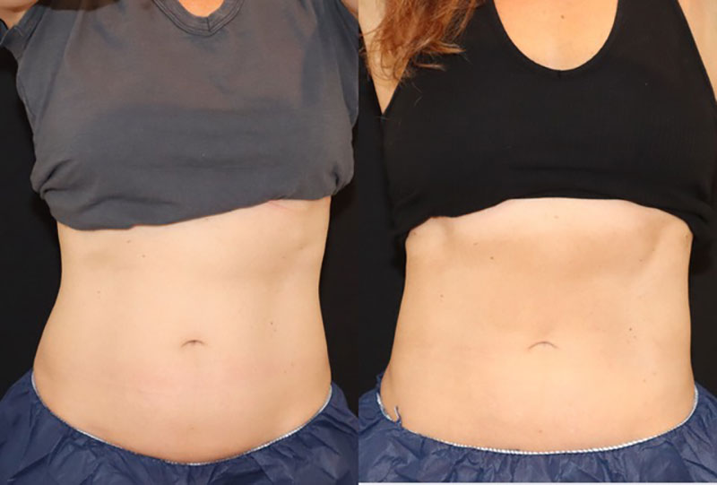 CoolSculpting Before & After Image