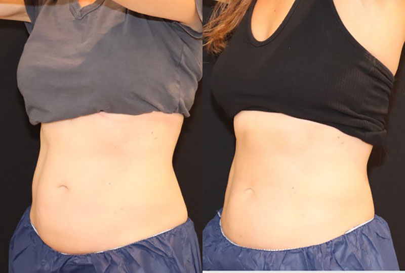 CoolSculpting Before & After Image