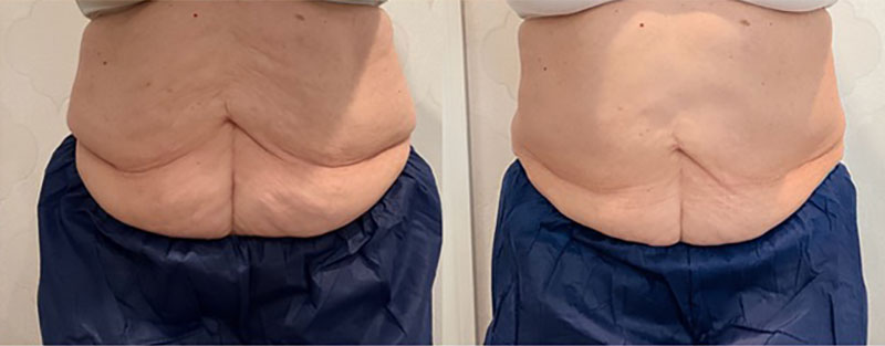 CoolSculpting Before & After Image