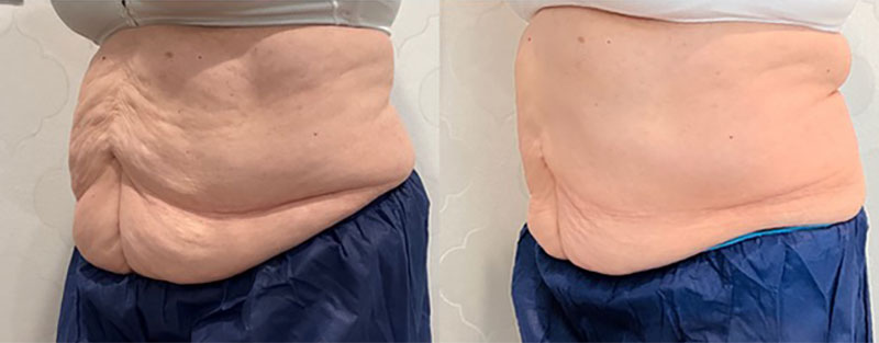 CoolSculpting Before & After Image