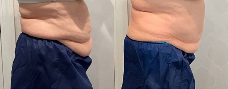 CoolSculpting Before & After Image