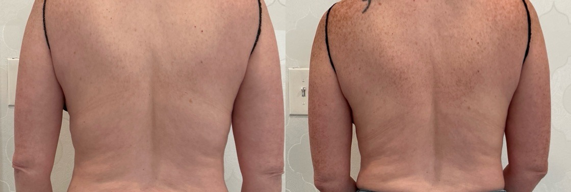 CoolSculpting Before & After Image