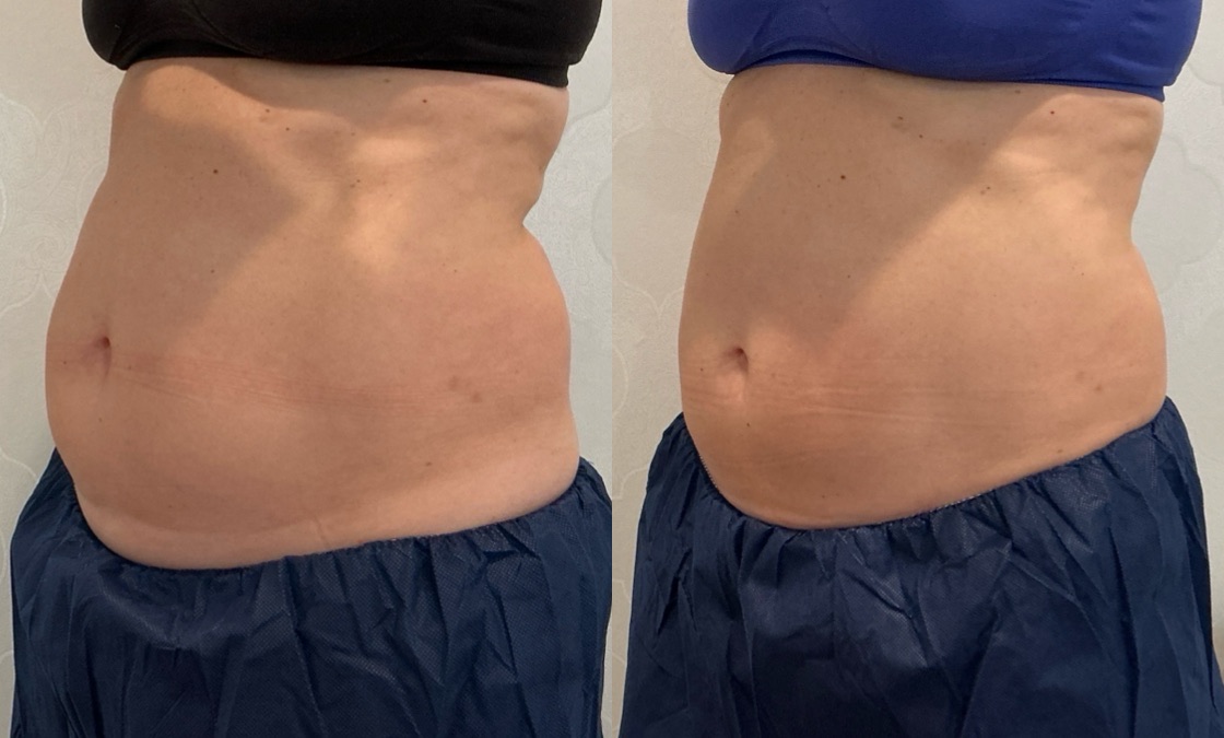 CoolSculpting Before & After Image