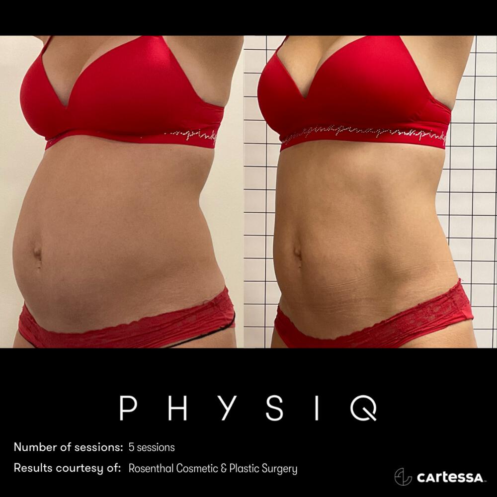 Physiq Before & After Image