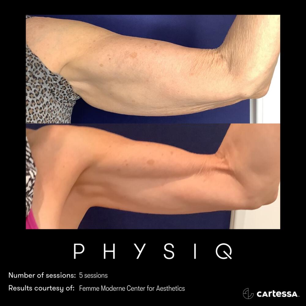 Physiq Before & After Image