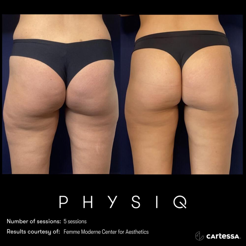 Physiq Before & After Image