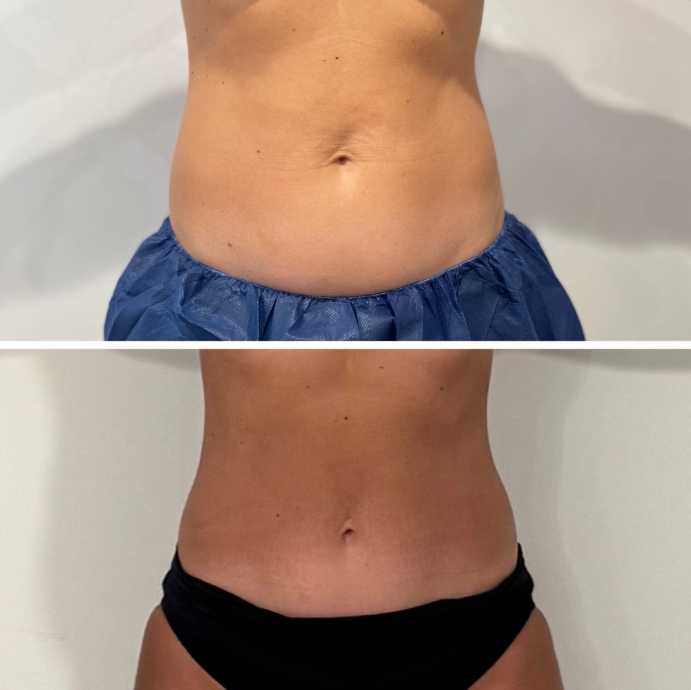 Physiq Before & After Image