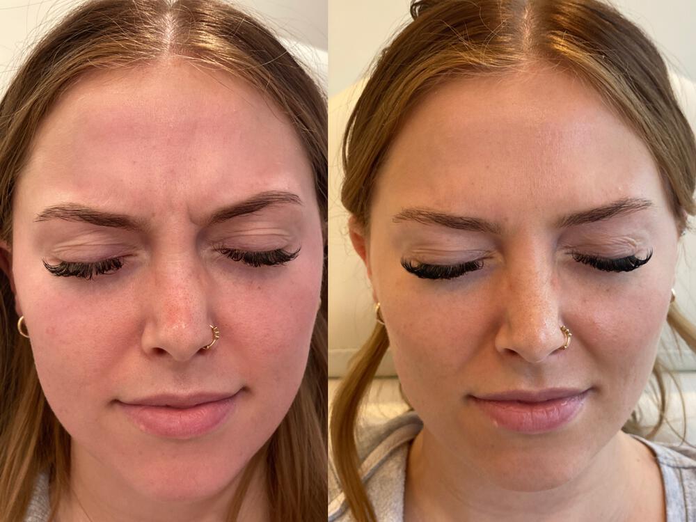 Botox Before & After Image