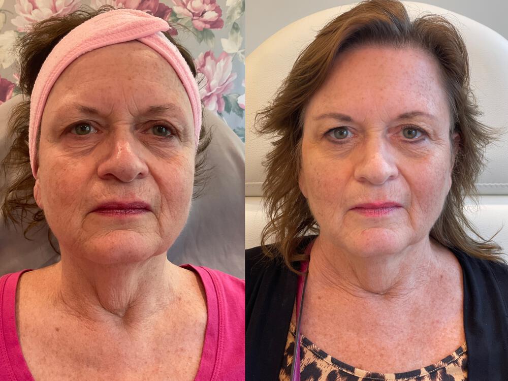 Botox Before & After Image