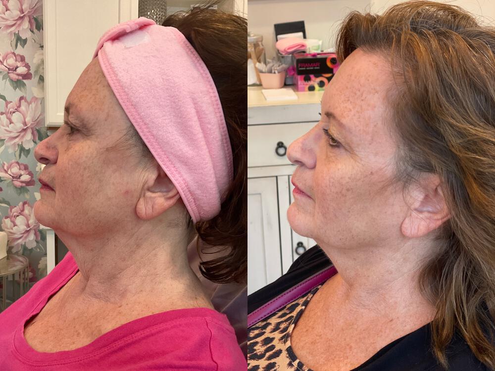 Botox Before & After Image