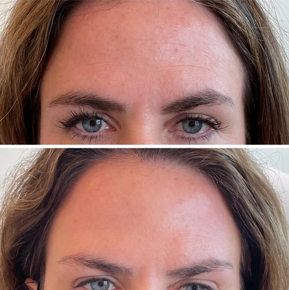 Botox Before & After Image