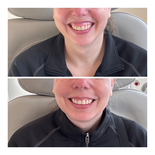 Botox Before & After Image