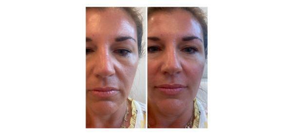 Dermal Fillers Before & After Image