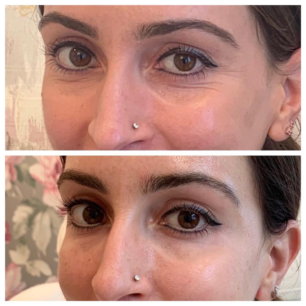 Dermal Fillers Before & After Image