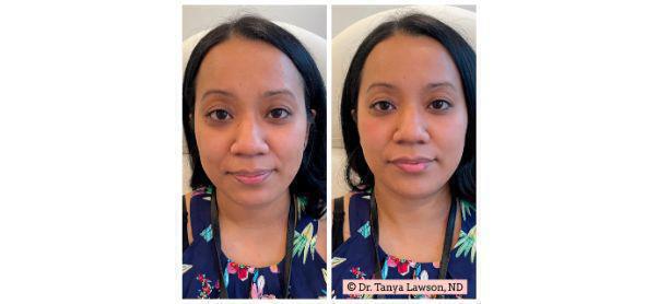 Dermal Fillers Before & After Image