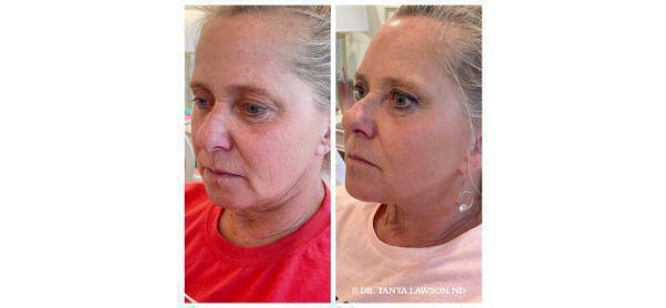 Dermal Fillers Before & After Image