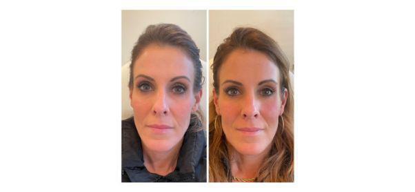 Dermal Fillers Before & After Image