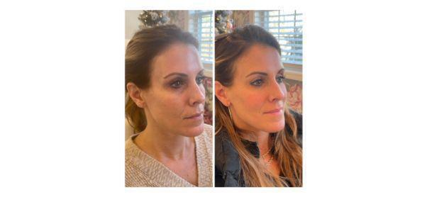 Dermal Fillers Before & After Image