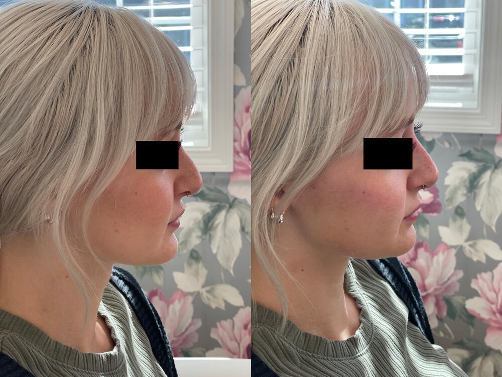 Dermal Fillers Before & After Image