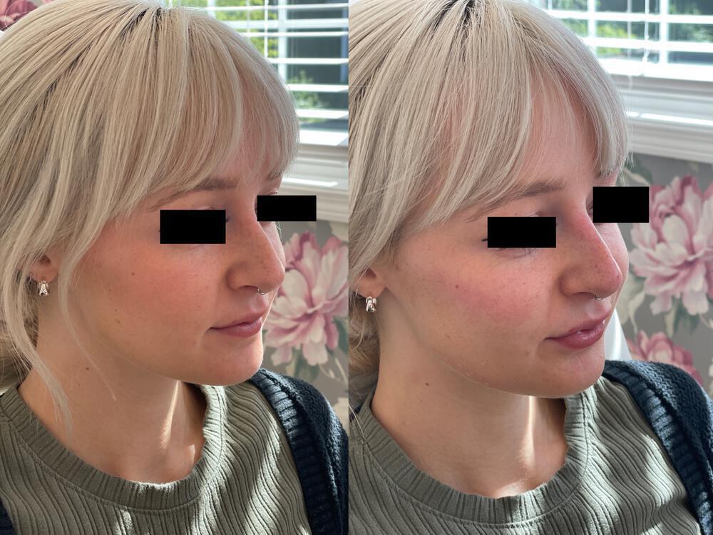 Dermal Fillers Before & After Image