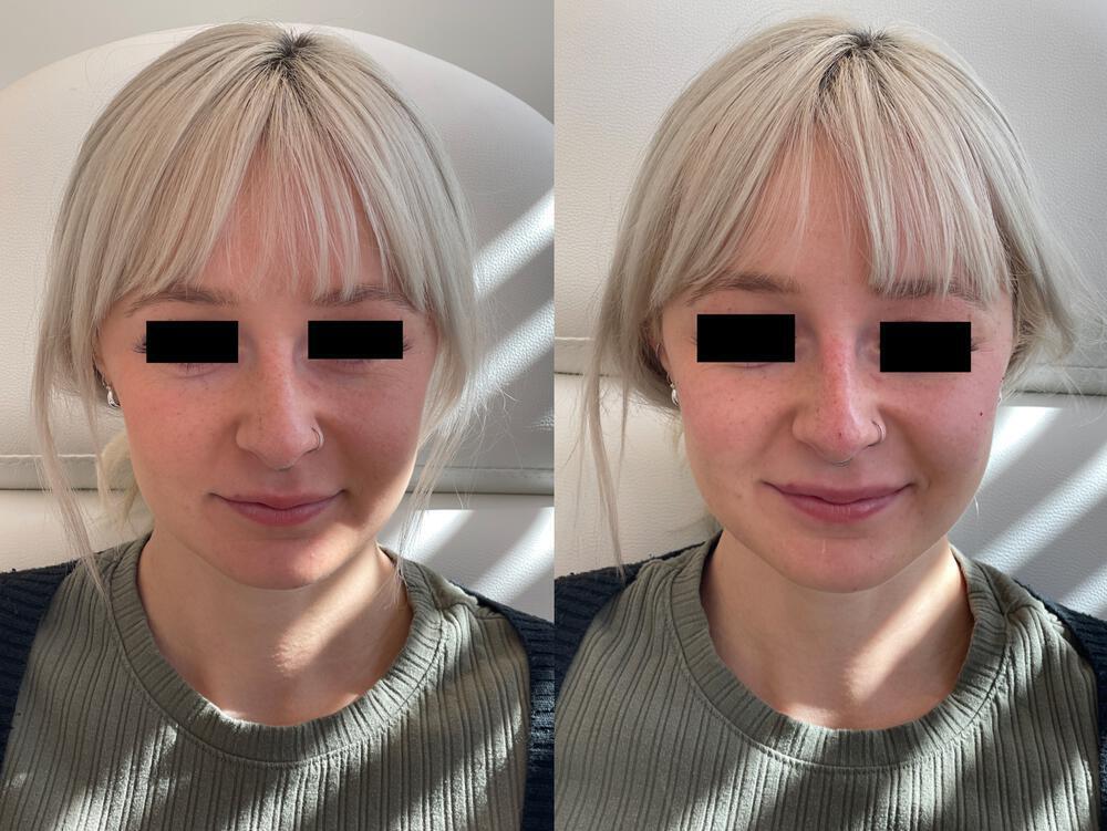 Dermal Fillers Before & After Image