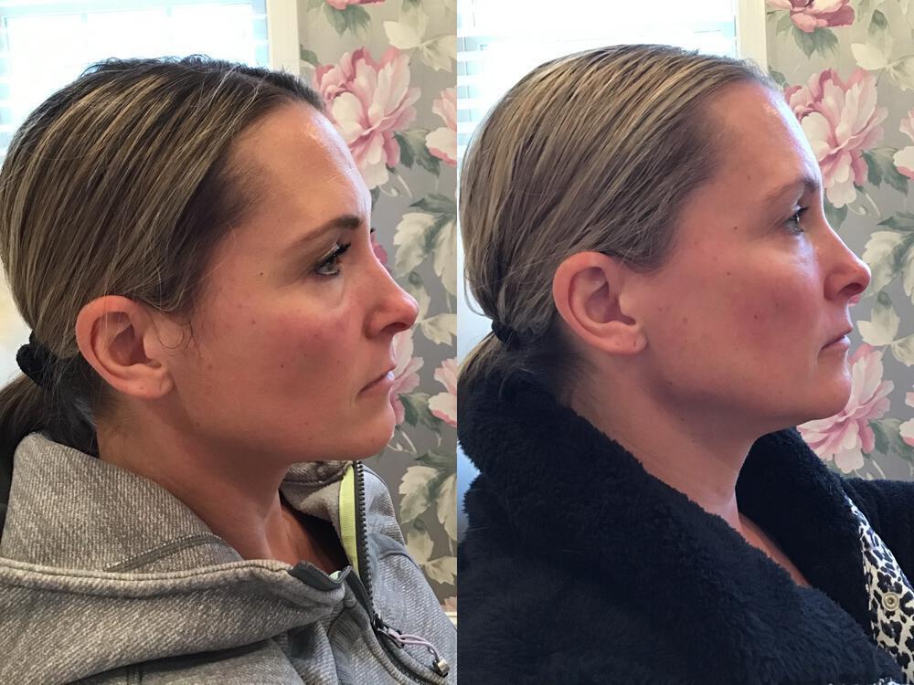 Dermal Fillers Before & After Image