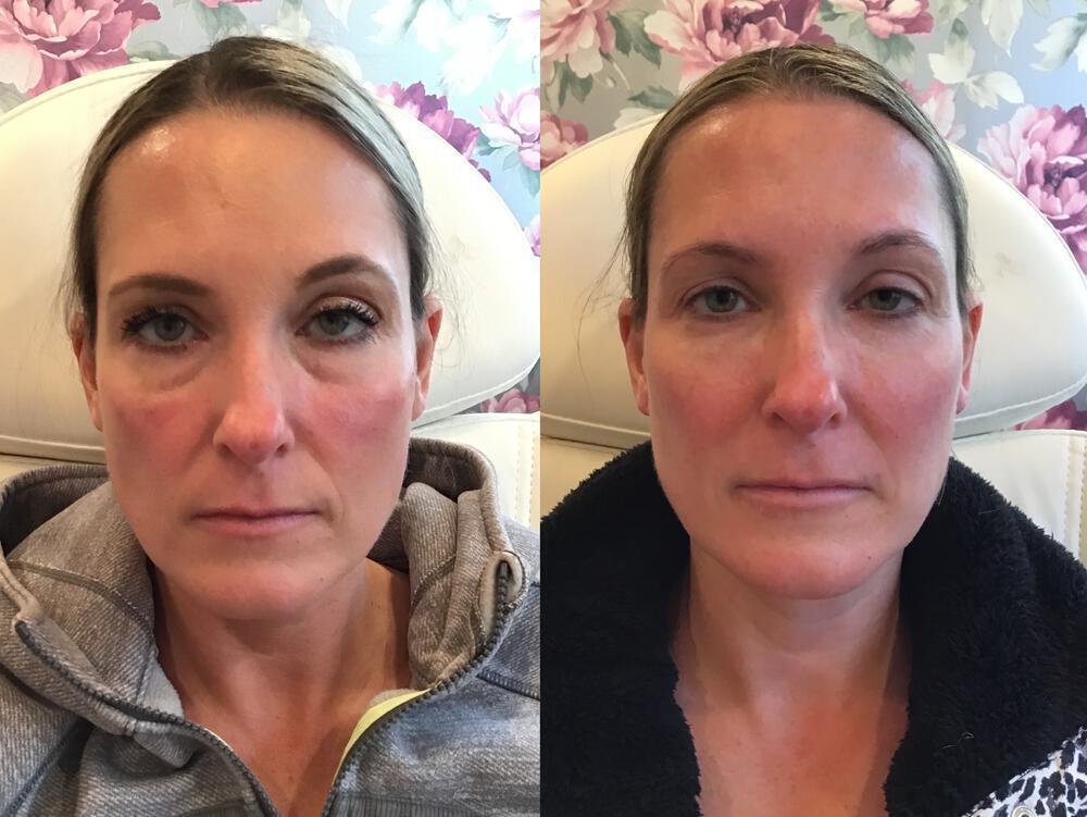 Dermal Fillers Before & After Image