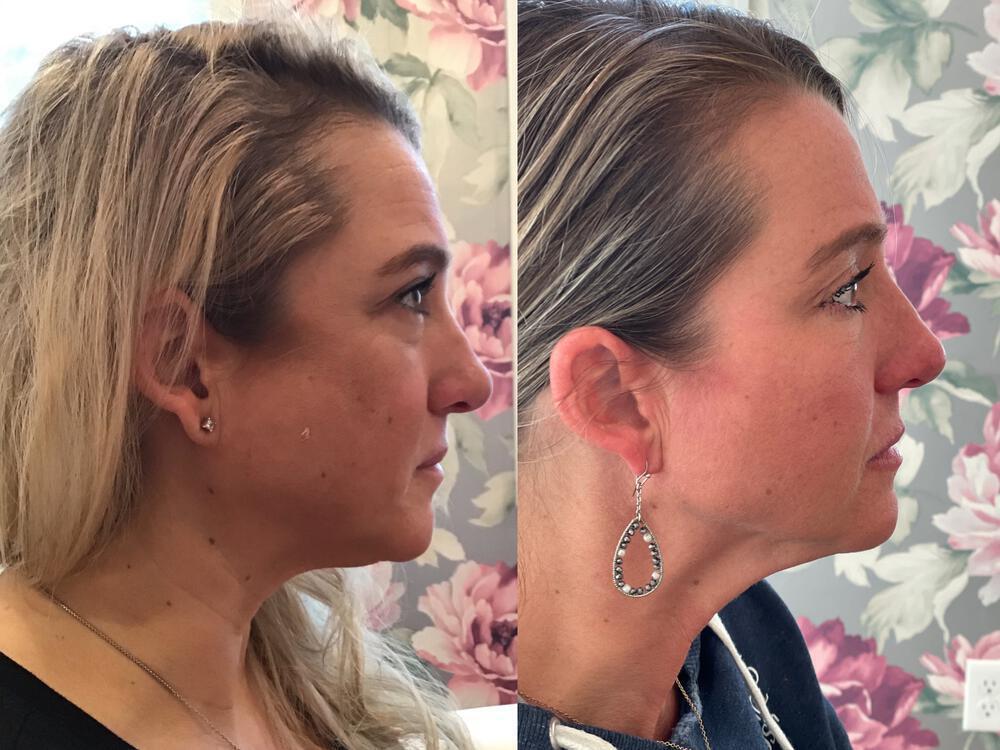 Dermal Fillers Before & After Image