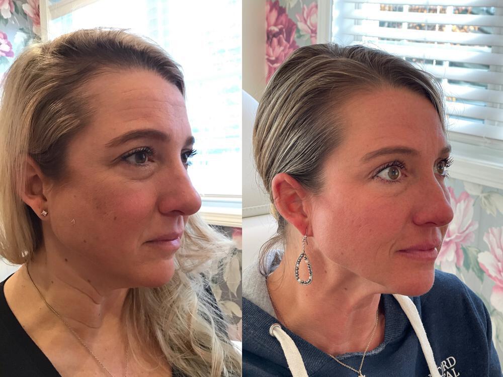 Dermal Fillers Before & After Image