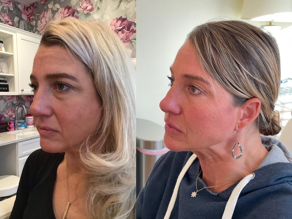 Dermal Fillers Before & After Image