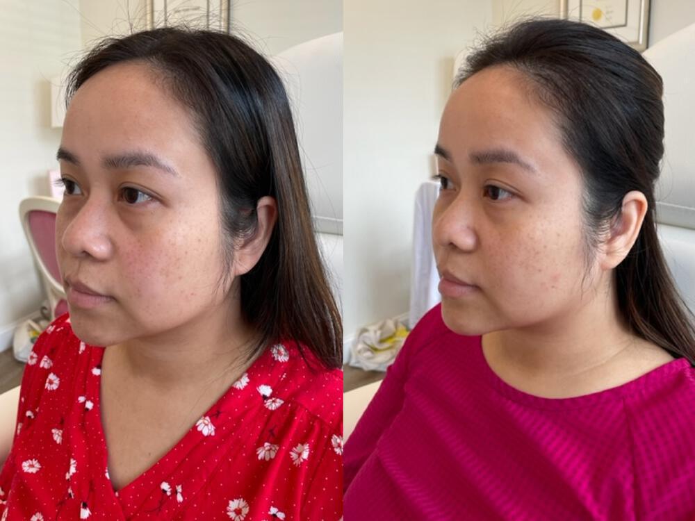 Dermal Fillers Before & After Image