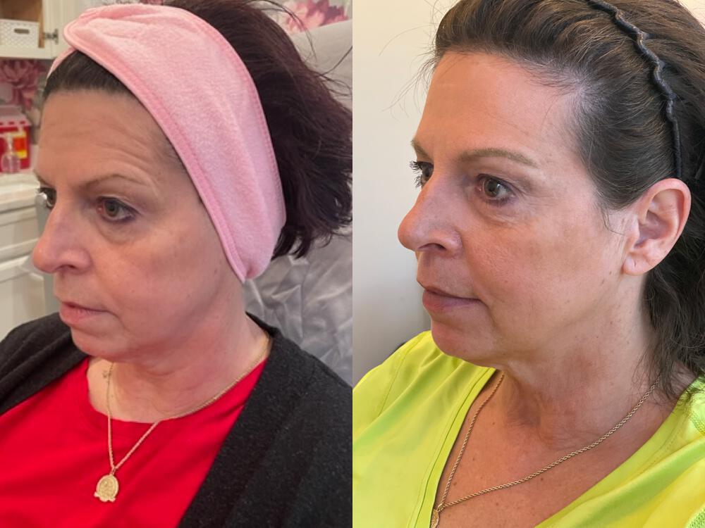 Dermal Fillers Before & After Image