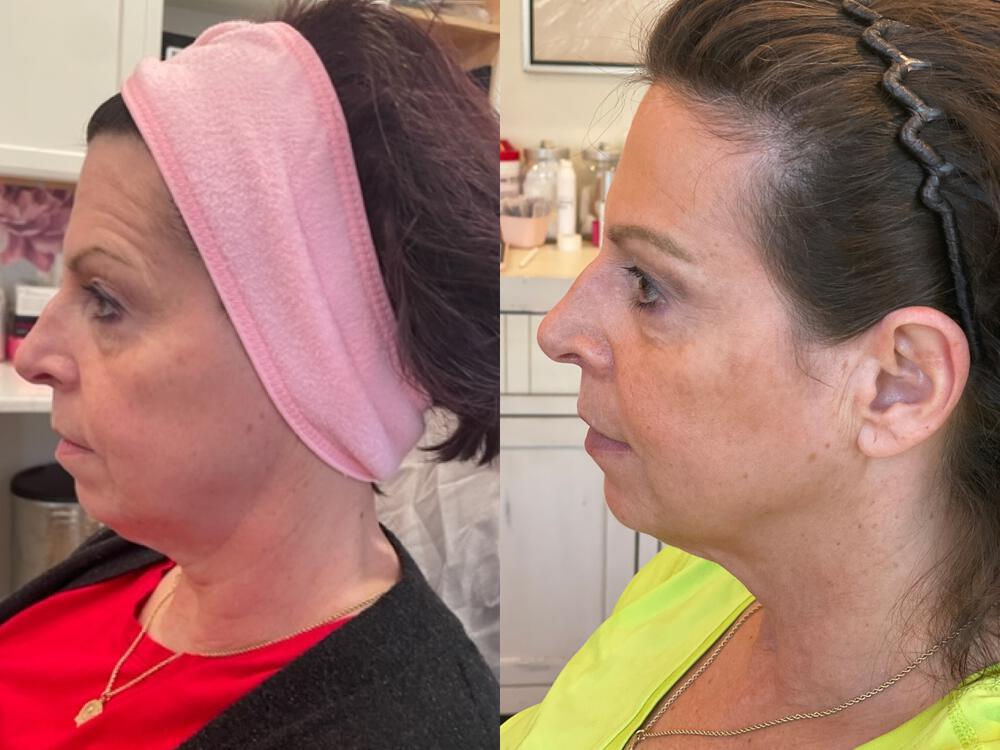 Dermal Fillers Before & After Image