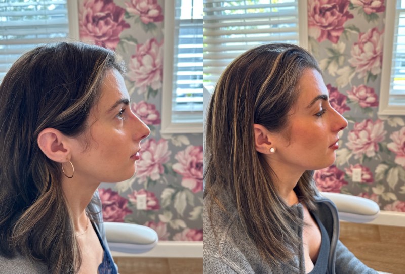 Dermal Fillers Before & After Image