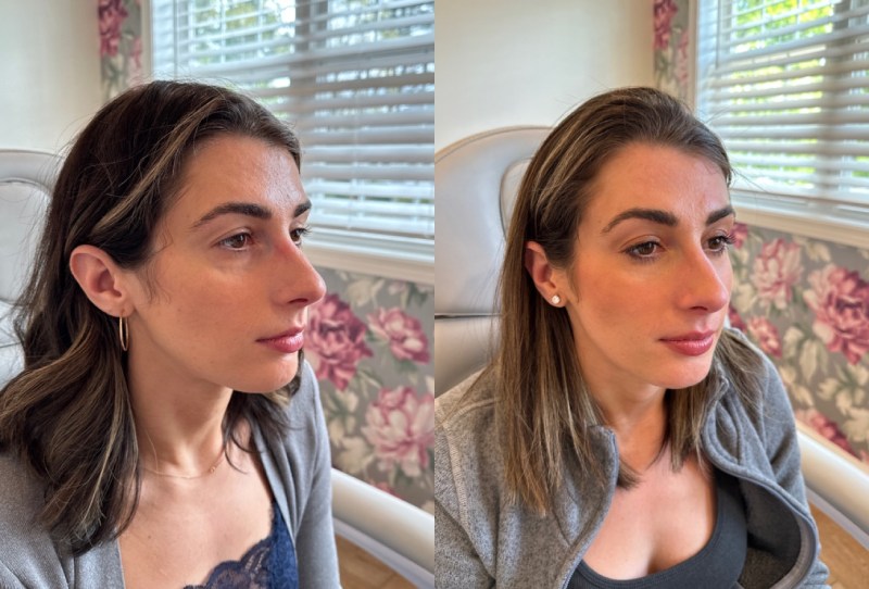 Dermal Fillers Before & After Image