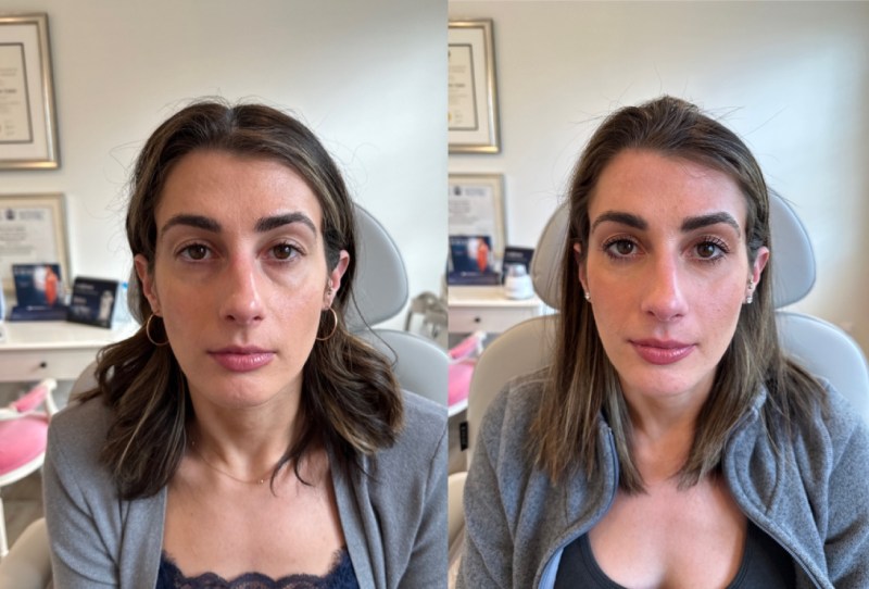 Dermal Fillers Before & After Image