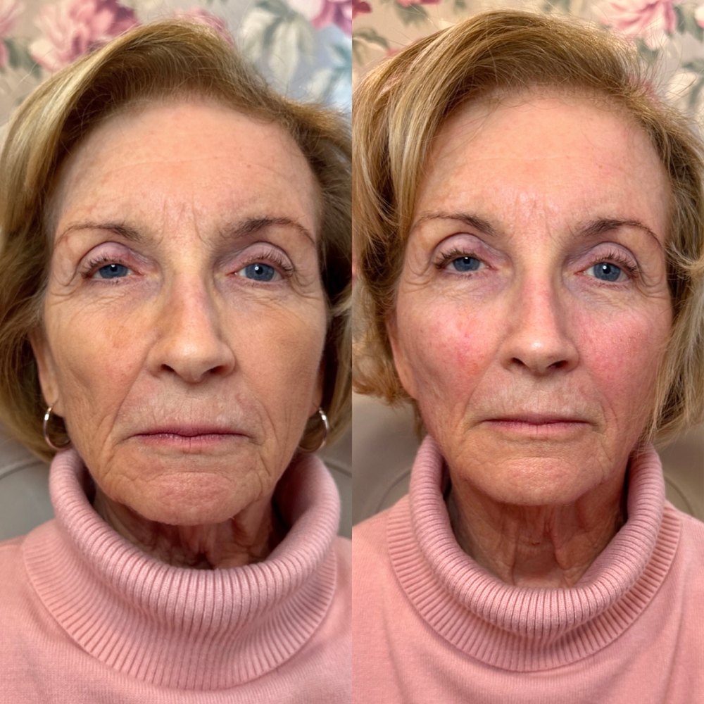 Dermal Fillers Before & After Image