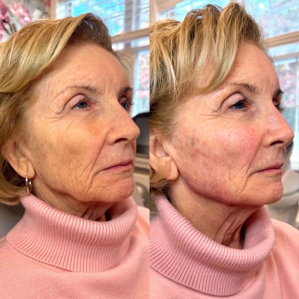 Dermal Fillers Before & After Image
