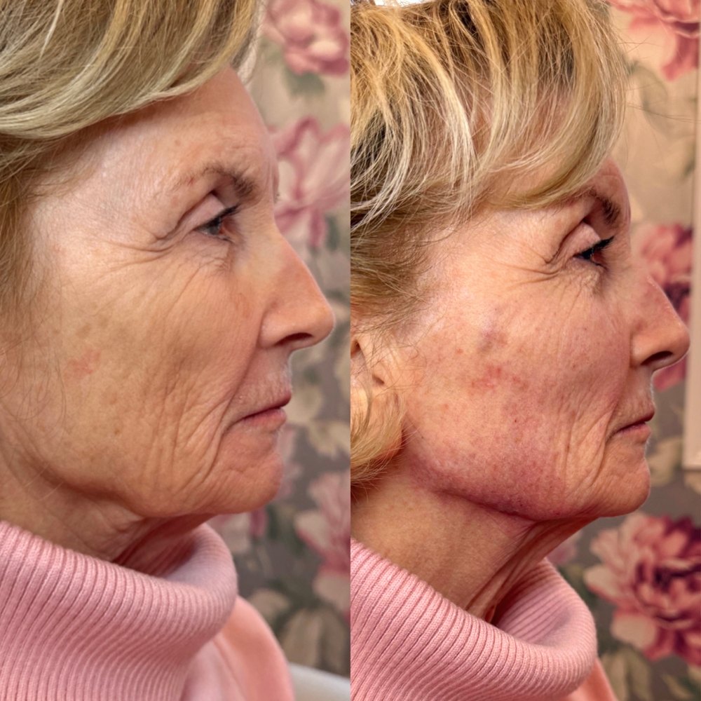 Dermal Fillers Before & After Image