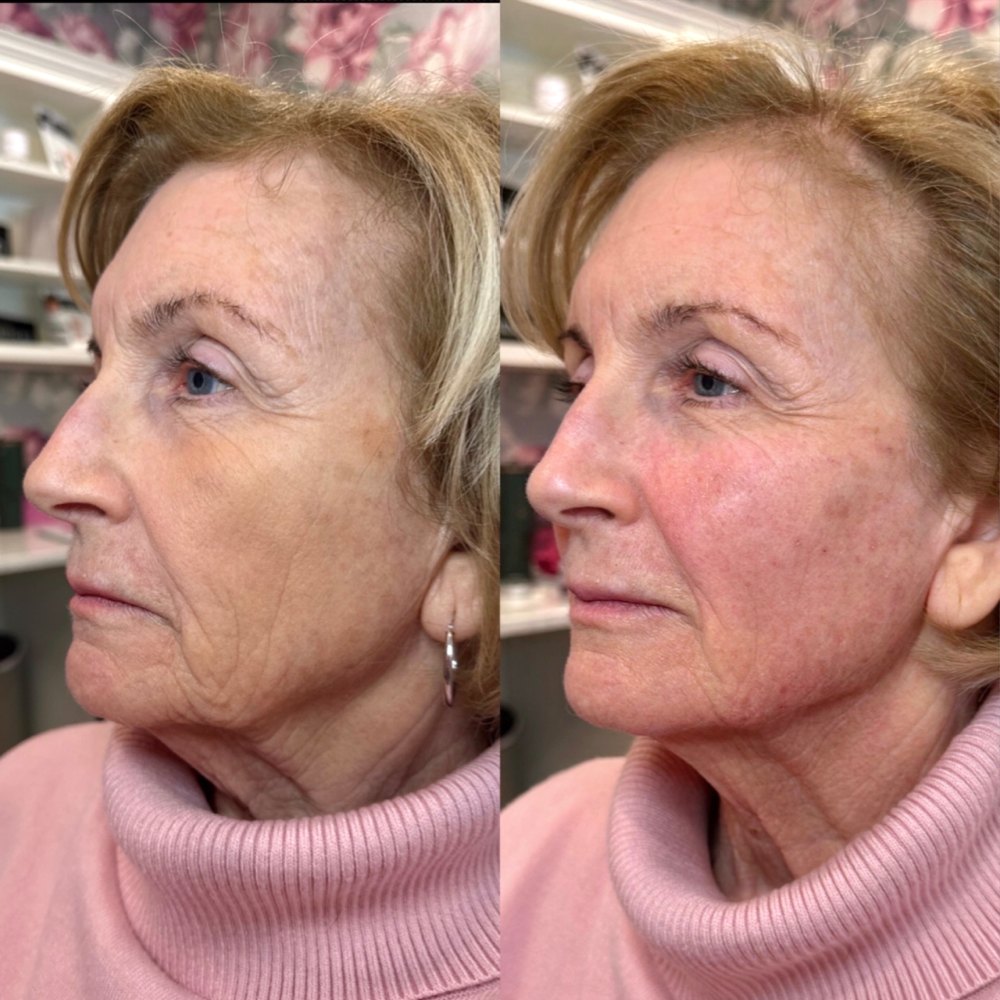 Dermal Fillers Before & After Image
