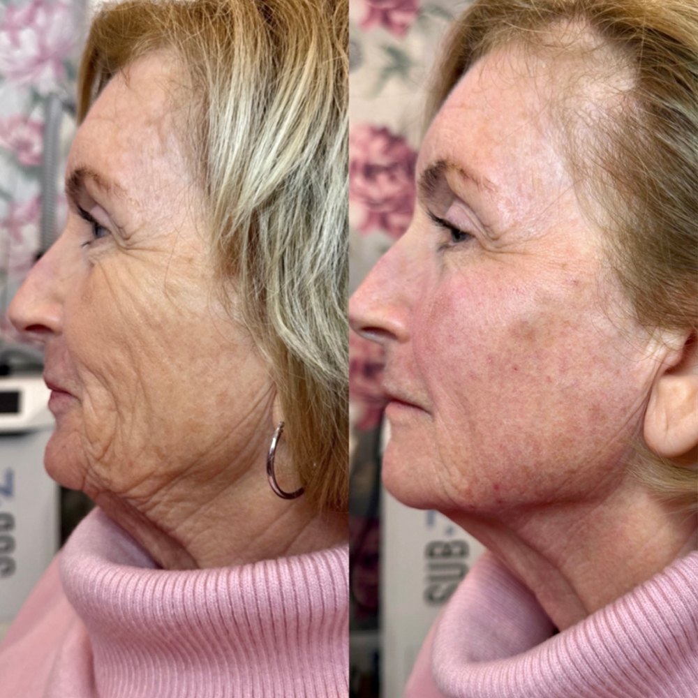 Dermal Fillers Before & After Image