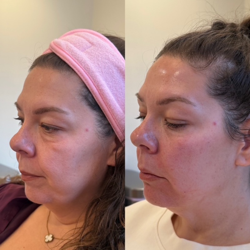 Dermal Fillers Before & After Image