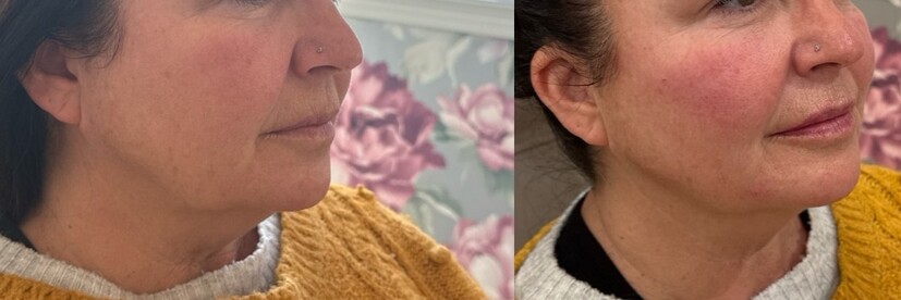 Dermal Fillers Before & After Image