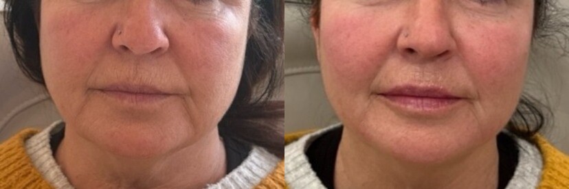 Dermal Fillers Before & After Image