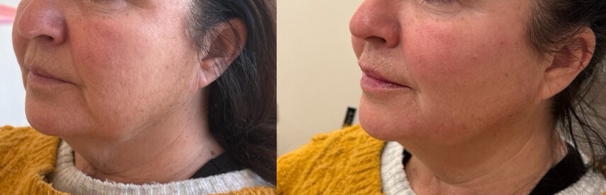 Dermal Fillers Before & After Image