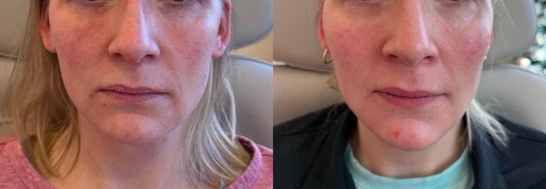Dermal Fillers Before & After Image