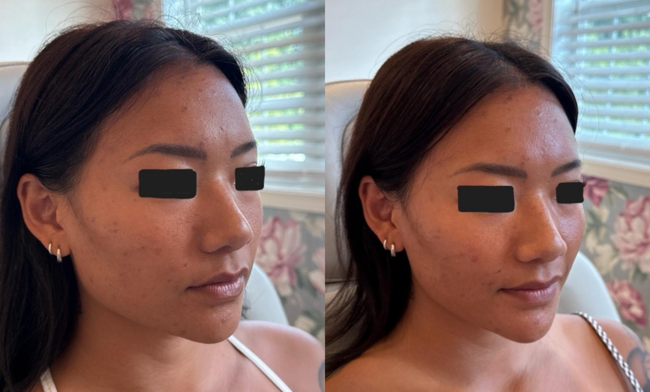 Dermal Fillers Before & After Image
