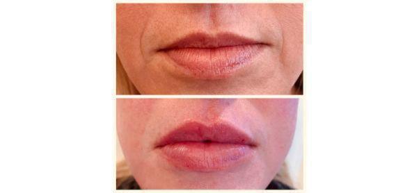 Lip Filler Before & After Image