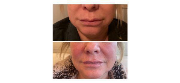 Lip Filler Before & After Image